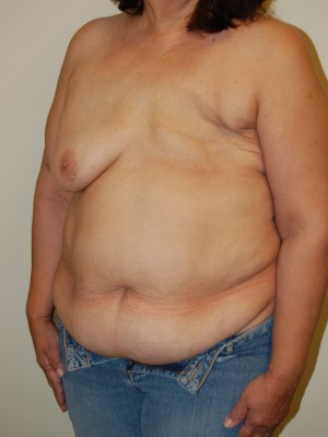 Breast Reconstruction Case 3944 Before Photo Breast Reconstruction