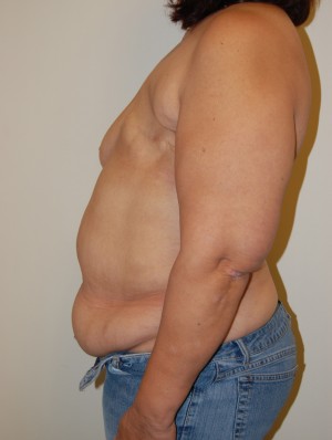 Breast Reconstruction Case 3944 Before Photo Breast Reconstruction