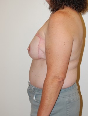 Breast Reconstruction Case 3952 After Photo Breast Reconstruction