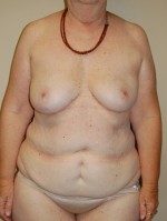 Breast Reconstruction