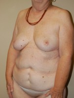 Breast Reconstruction