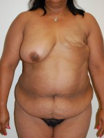 Breast Reconstruction