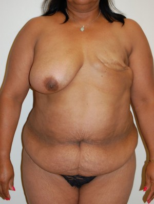 Breast Reconstruction Case 3968 Before Photo Breast Reconstruction