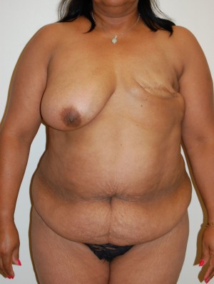 Breast Reconstruction