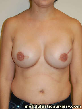 Breast Reconstruction