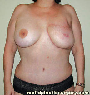 Breast Reconstruction Case 3994 After Photo Breast Reconstruction