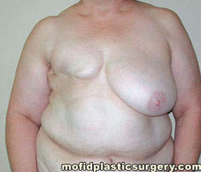 Breast Reconstruction Case 4002 Before Photo Breast Reconstruction
