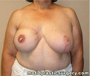 Breast Reconstruction Case 4002 After Photo Breast Reconstruction