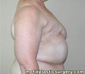 Breast Reconstruction Case 4002 Before Photo Breast Reconstruction