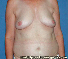 Breast Reconstruction Case 4010 Before Photo Breast Reconstruction