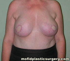 Breast Reconstruction Case 4010 After Photo Breast Reconstruction