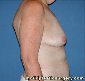 Breast Reconstruction Case 4010 Before Photo Breast Reconstruction