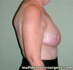 Breast Reconstruction