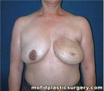 Breast Reconstruction