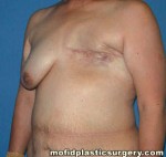 Breast Reconstruction