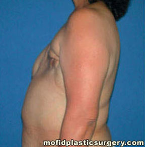 Breast Reconstruction Case 4016 Before Photo Breast Reconstruction