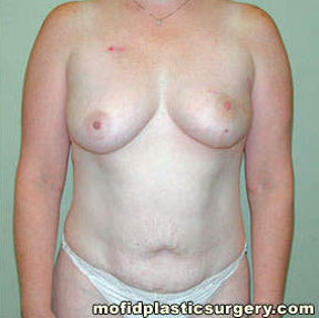 Breast Reconstruction Case 4024 Before Photo Breast Reconstruction
