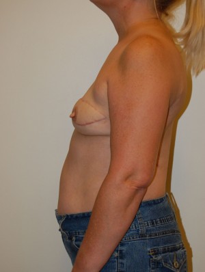 Breast Reconstruction Case 4038 After Photo Breast Reconstruction