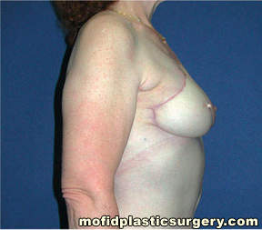 Breast Reconstruction Case 4070 After Photo Breast Reconstruction