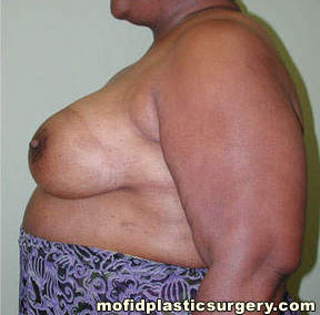 Breast Reconstruction Case 4084 After Photo Breast Reconstruction