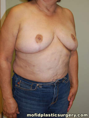 Breast Reconstruction Case 4090 Before Photo Breast Reconstruction