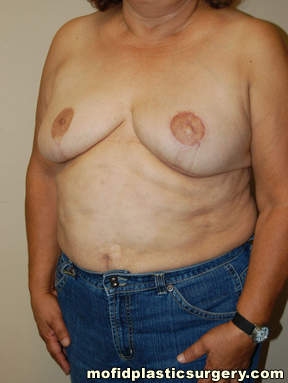Breast Reconstruction Case 4090 After Photo Breast Reconstruction