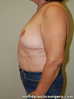 Breast Reconstruction Case 4090 Before Photo Breast Reconstruction