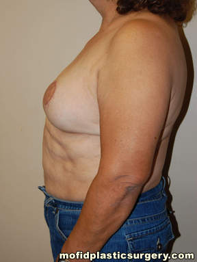 Breast Reconstruction Case 4090 After Photo Breast Reconstruction