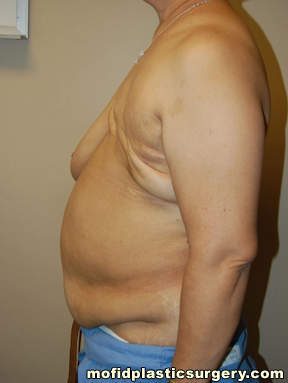 Breast Reconstruction Case 4100 Before Photo Breast Reconstruction