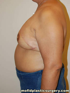 Breast Reconstruction Case 4100 After Photo Breast Reconstruction