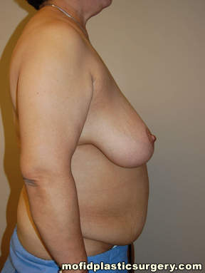 Breast Reconstruction Case 4100 Before Photo Breast Reconstruction