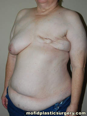 Breast Reconstruction Case 4126 Before Photo Breast Reconstruction