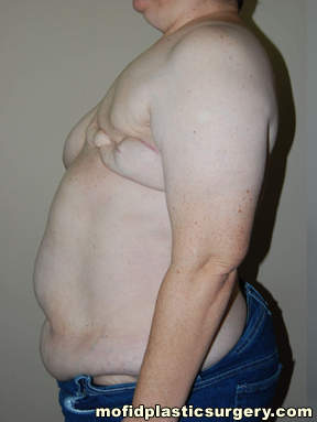 Breast Reconstruction Case 4126 Before Photo Breast Reconstruction