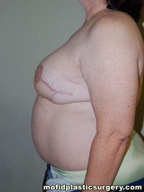 Breast Reconstruction Case 4126 After Photo Breast Reconstruction