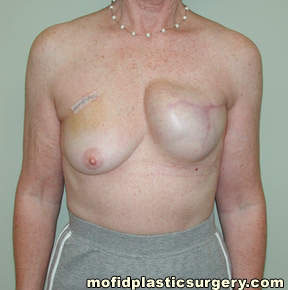 Breast Reconstruction Case 4134 Before Photo Breast Reconstruction