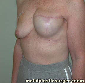 Breast Reconstruction Case 4134 Before Photo Breast Reconstruction