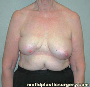 Breast Reconstruction Case 4150 Before Photo Breast Reconstruction