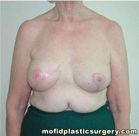 Breast Reconstruction