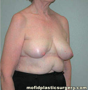 Breast Reconstruction Case 4150 Before Photo Breast Reconstruction