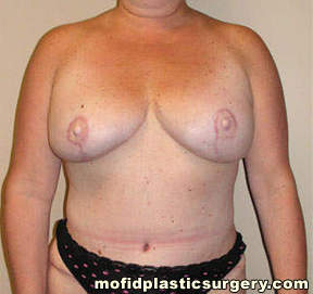 Breast Reconstruction Case 4158 After Photo Breast Reconstruction