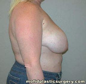 Breast Reconstruction