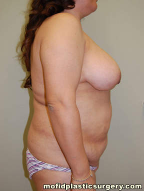 Breast Reconstruction Case 4166 Before Photo Breast Reconstruction