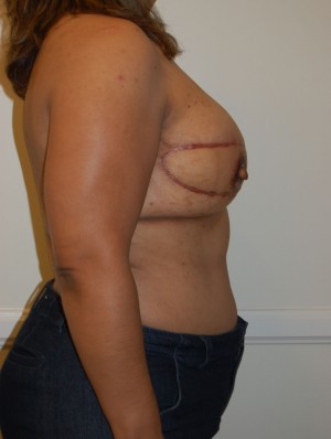 Breast Reconstruction Case 4184 After Photo Breast Reconstruction