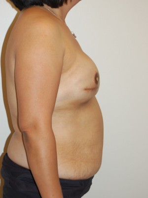 Breast Reconstruction Case 4193 After Photo Breast Reconstruction