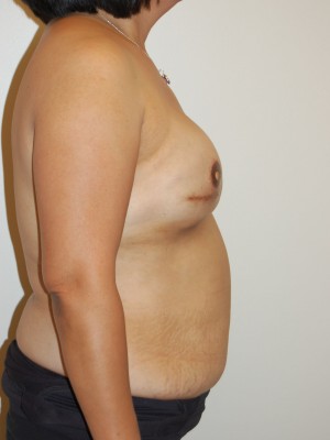 Breast Reconstruction