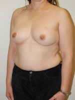 Breast Reconstruction