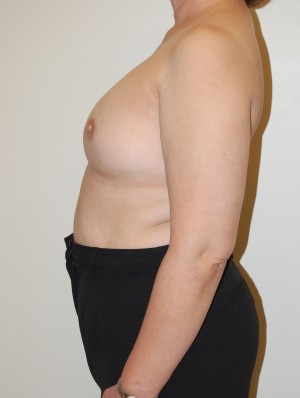 Breast Reconstruction