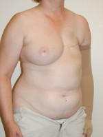 Breast Reconstruction