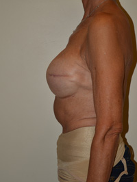 Breast Reconstruction