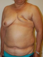Breast Reconstruction